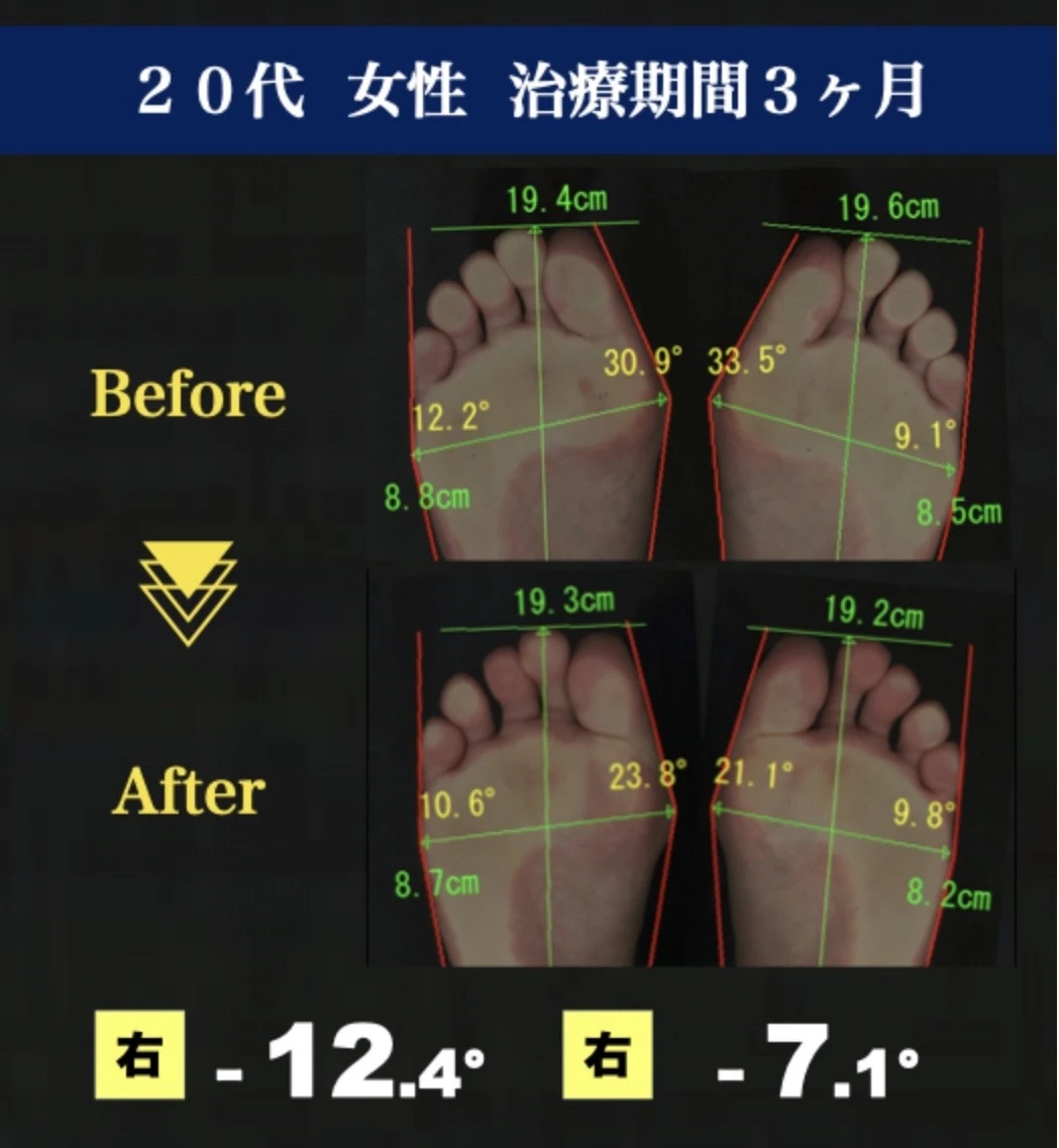 外反母趾が全身に及ぼす影響を知ろう！身体の不調の原因は外反母趾に？